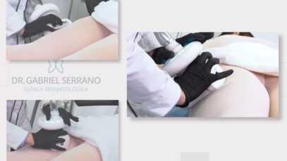 TRATAMIENTO-INTEGRAL-CELULITIS-PLAY